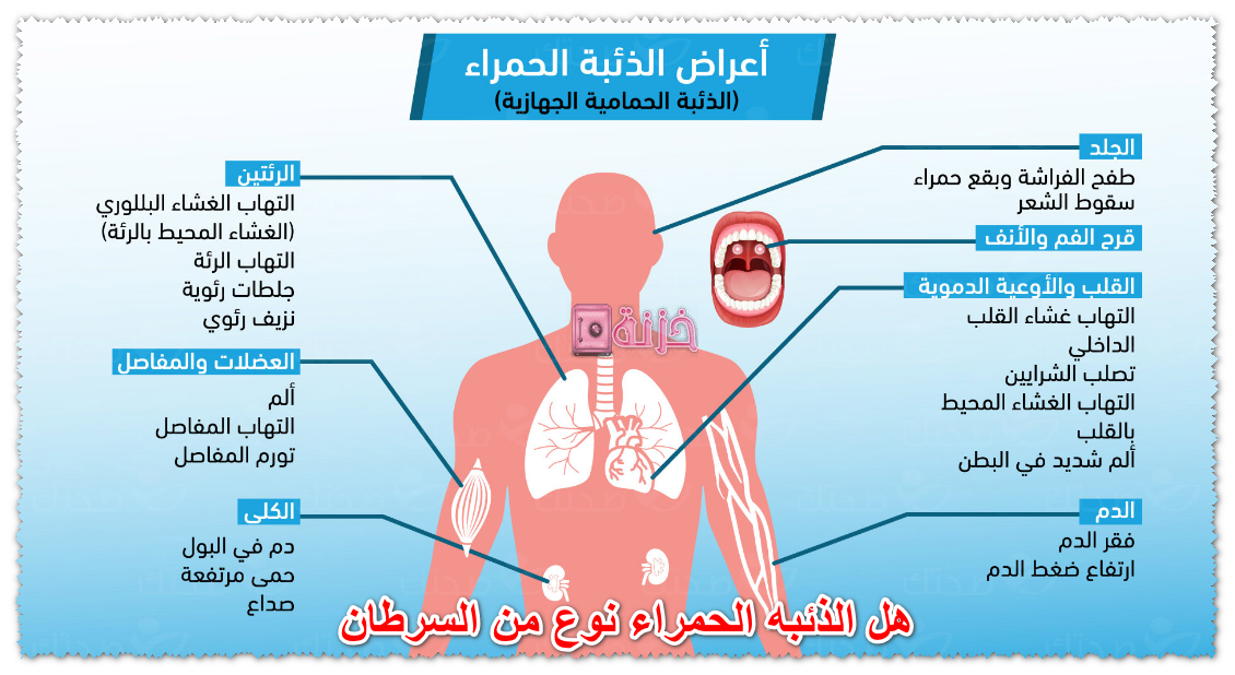 هل الذئبه الحمراء نوع من السرطان